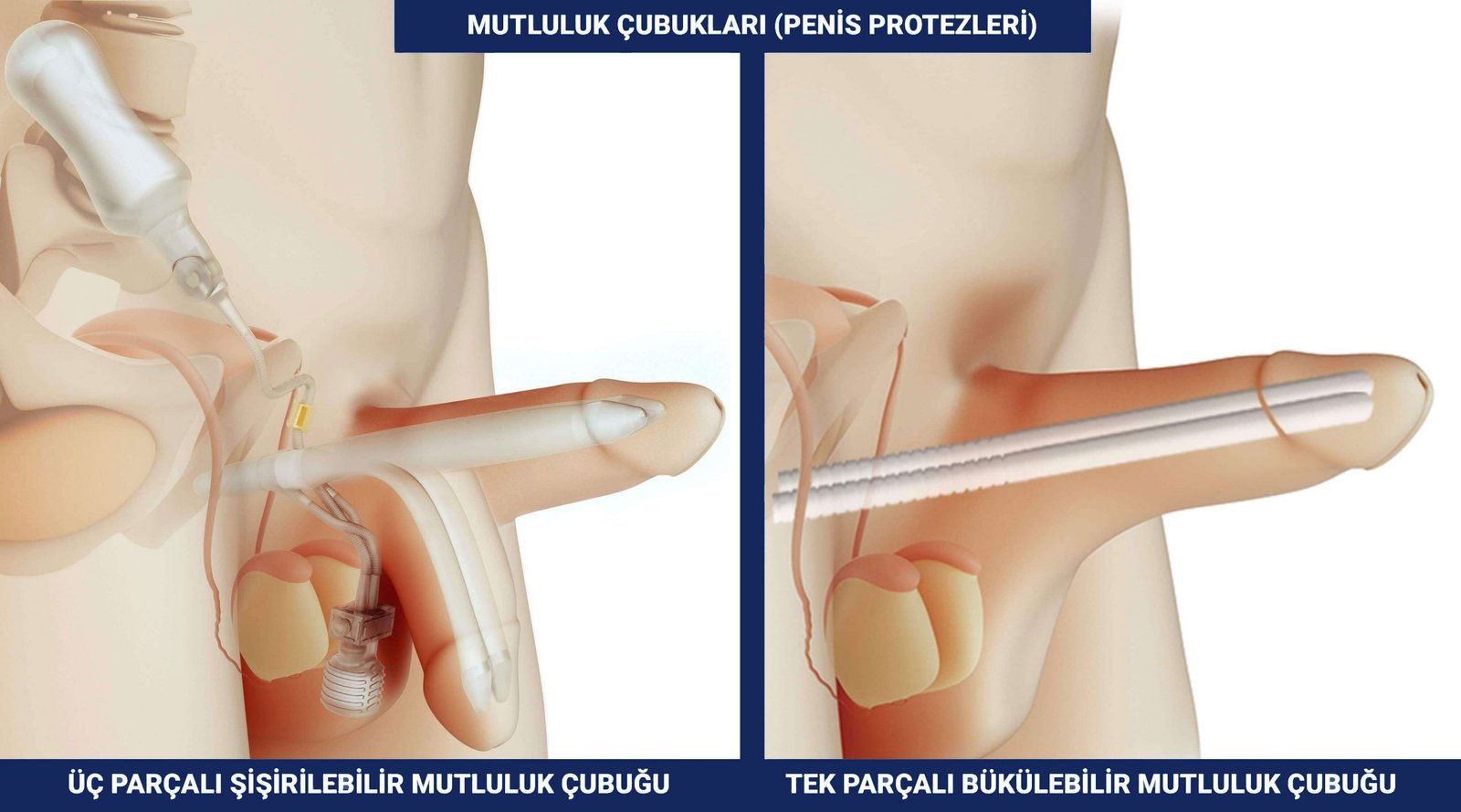 Penil Protez Çeşitleri